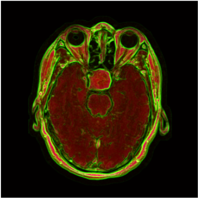 AI-Powered Brain Tumor Segmentation